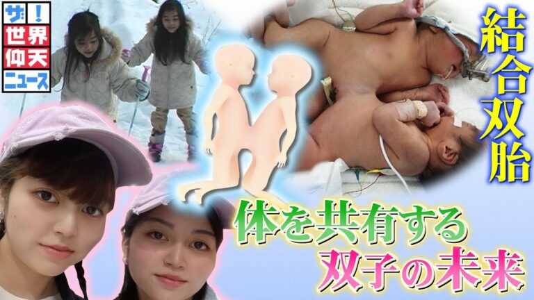 まさに奇跡の生活を送る双子【ザ!世界仰天ニュース】